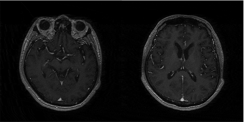 Figure 2. Enhanced MRI: no abnormal signal intensity in papillary body, thalamus, periaqueduct of the midbrain, cerebellar, brainstem