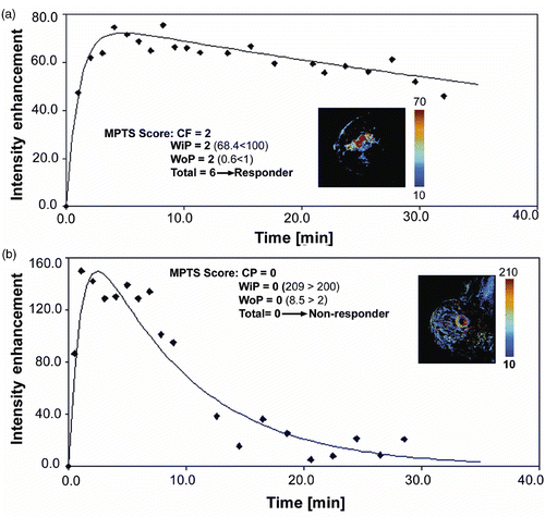 Figure 6. (a) Example of a 53-year-old patient (T4dNx at diagnosis) with a MPTS score of 6 who ultimately was a pathological complete responder (pT0N0). Shown here are the WiP parametric map with centrifugal morphology, and an enhancement curve with low WiP and WoP; (b) Example of a 64-year-old patient (T2N1 at diagnosis) with an MPTS score of 0 who was ultimately a pathological non-responder (pT2N1). The WiP parametric map shows centripetal morphology, and the WiP and WoP are high.