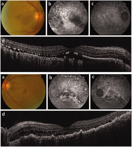 Figure 1. Right and left eye posterior segment imaging for case 1. (a) Color photography; (b) fundus fluorescein angiography (FFA); (c) autofluorescence imaging; and (d) spectral domain optical coherence tomography (OCT) imaging. Note the patchy retinal pigment epithelium loss on OCT with corresponding hyperfluorescence on FFA and hypoautofluorescence. The right OCT shows loss of the ellipsoid zone, which explains the marked reduction in visual acuity. OCT also reveals shallow serous macular detachments, particularly of the right eye.