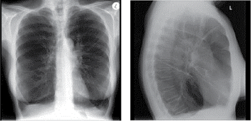 Figure 4. Hyperinflated, hyperlucent lungs fields and scattered bronchiectasis evident on chest X-ray in a patient with α1-antitrypsin deficiency-related chronic obstructive pulmonary disease.