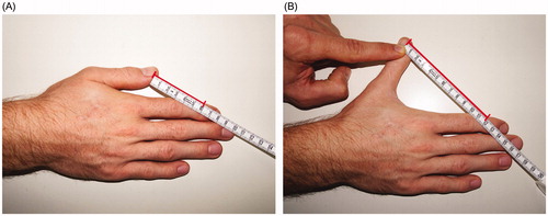 Figure 6. Thumb-DIP method represents the distance (red bar) between the distal-ulnar thumb nail fold and the radial edge of the flexion crease of the index finger’s distal interphalangeal joint in radial adduction (A) and radial abduction (B).