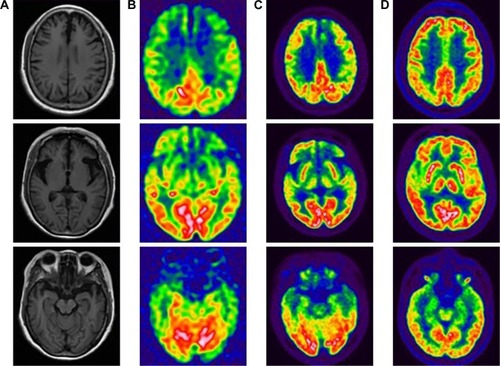 Figure 2 The neuroimaging of the proband and her sibling. For the proband, the T1-weighted axial MRI scan showed bilateral asymmetry of frontotemporal atrophy, more significant on the left (A). The predominantly frontotemporal hypoperfusion and hypometabolism were observed on ASL-MRI (B) and FDG-PET (C), respectively, in the proband. FDG-PET studies in her sibling (IV4, mutation carrier, indexed in Figure 1) revealed no significant abnormalities on visual inspection (D).