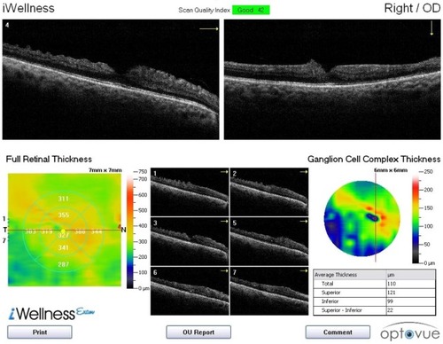 Figure 9 Category 2 subject (J911) with an epiretinal membrane and vitreomacular traction.