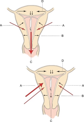 Figure 2 Direction of uterine forces in the normal intrauterine device containing uterus are given at (A–D) in the top diagram.