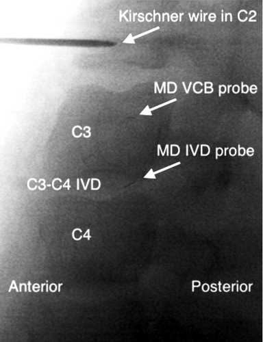 Figure 1. Representative fluoroscopic image showing the location of the microdialysis (MD) probes in a sagittal view: the Kirschner wire with the fixating device in the C2 vertebral body, C3 and C4 vertebral body, C3–C4 intervertebral disc (IVD), the gold thread within the microdialysis probe membrane tip in the vertebral cancellous bone (VCB) and intervertebral disc.