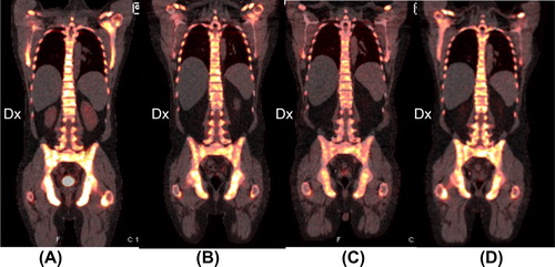 Figure 1. Sodium [18F] fluoride PET (NAF PET) response. Four repeated NAF PET/CT scans in coronal view before (Figure 1A), and 2 weeks (Figure 1B), 2 months (Figure 1C) and 5 months (Figure 1D) after the start of vismodegib treatment. A generalized uptake of NAF is seen in Figure 1A. The intensity of uptake in the pelvic and hip bone has decreased in Figure 1B, and remains unchanged in Figure 1C. The uptake in the skeleton is still heterogeneous in Figure 1D, and has increased slightly.