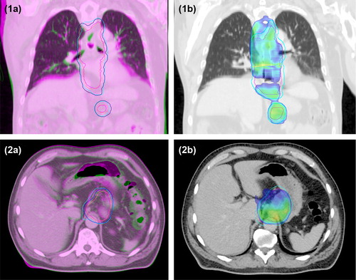 Figure 1. 1a) and 2a), Overlay of planning CT scan (green) and additional CT scan at fraction 11 (magenta); 1b) and 2b), The recalculated dose distribution on the additional CT scan, with 95% of the prescribed dose shown in colour wash; All images, Pink line, CTVtotal on planning CT scan; Blue line, PTV on planning CT scan; Magenta line, CTVtotal on additional CT scan; Cyan line, PTV on additional CT scan. Case 1), Changes in the diaphragmatic base line and the mediastinum shifted the CTVtotal and PTV towards the patient's left side causing underdosage near the top of the diaphragm and to the left in the mediastinum. The CTV and PTV were underdosed, showing decreases in V95% of the CTV of 5% and of the PTV of 12%. Case 2), Changes in the bowel filling and bowel gas shifted the CTVtotal and PTV towards the patient's right side and slightly to the posterior, causing underdosage in the PTV which had a decrease in V95% of 11%.