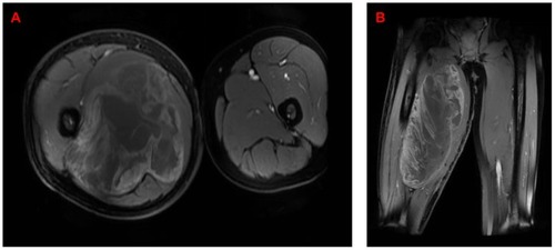 Figure 1 Representative images of MRI (A&B).