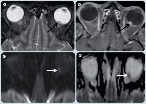 Figure 12. Orbital melanoma.Axial T2-weighted image (WI) (A), axial T1-WI fat-supressed post-gadolinium (B), diffusion weighted (C), and apparent diffusion coefficient map (D) MR images. A small single lesion (black arrow) is seen in the posterior and medial-center aspect of the left globe. It has low signal on T2-WI (A) relative to the vitreous and avid enhancement in postcontrast image (B). On diffusion WIs there is restricted diffusion in the mass (arrows) (C & D).