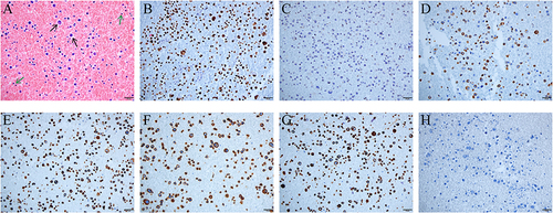 Figure 2 Histopathologic examination of a paraffin-embedded tissue section from pericardial effusion. (A) Hematoxylin-eosin (HE) staining. Scale bars: 50μm. Black arrow: cancer cells; Green arrow: immune cells. (B) TTF-1 (+). (C) P40 (-). (D) NapsinA (+). (E) Muc4 (+). (F) MOC31 (+). (G) CK7 (+). (H) PD-L1 tumor proportion score (TPS)=0. Technical details are provided in Table S2.