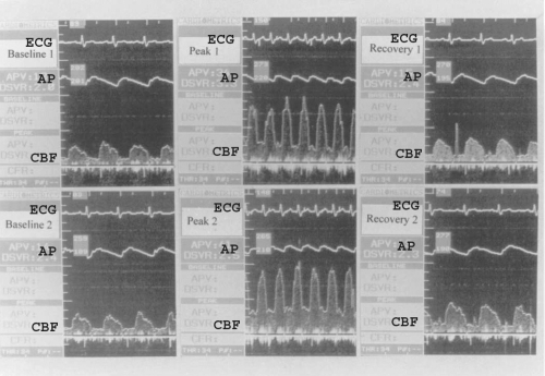 Figure 2 Representative coronary blood flow (CBF) of left anterior descending artery of a postmenopausal woman in the treated group at the two atrial pacing (AP) protocols before (upper panel) and after estrogen administration (low panel).Abbreviations: AP, aortic pressure; ECG, electrocardiogram.