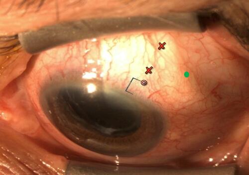 Figure 8 Entry points for SLX procedure: ideal conjunctival entry point [green dot]; ideal scleral entry point [target circle] and red crosses showing conjunctival entry points are either too close or too far back. Image courtesy of Sebastien Gagne, MD.