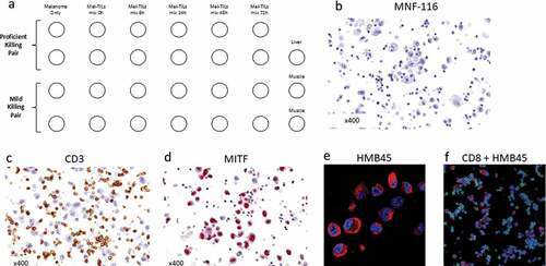 Figure 2. Immune Co-Culture Cell Microarray (ICCM) map and validation processes. (a) A Map of the ICCM block; (b) MNF-116 stain, an epithelial marker, demonstrating negative stains among morphologically intact TILs and melanoma cells in an entire core; (c) CD3 membranal stain, positive in TILs and negative in melanoma cells; (d) MITF nuclear stain, positive in melanoma cells and negative in TILs; (e) HMB45 cytoplasmic and membrane stain positive in melanoma cells combined with DAPI nuclear stain (blue); (f) HMB45 cytoplasmic and membrane stain (positive in melanoma cells) combined with CD8 membranal stain (positive in TILs) and DAPI (blue). Overall, this figure demonstrated no nonspecific stains, supporting the specificity of the ICCM
