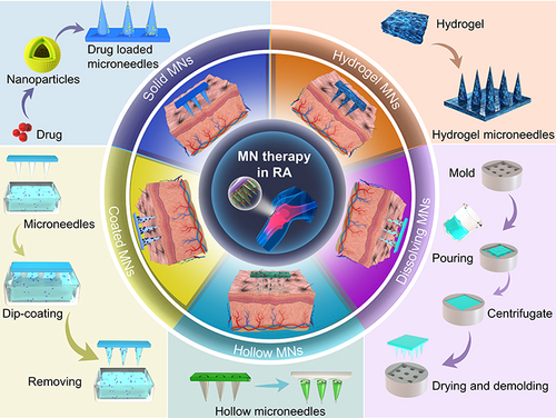 Figure 1 Application of different types of microneedles in RA.