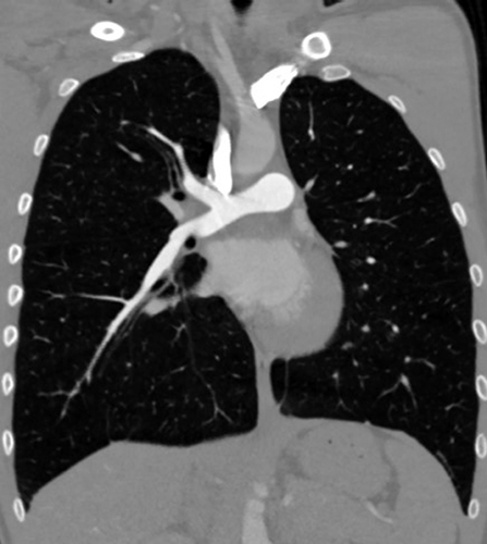 Figure 4 CT angiography findings 9 months following the initial diagnosis: complete resolution of the PE.