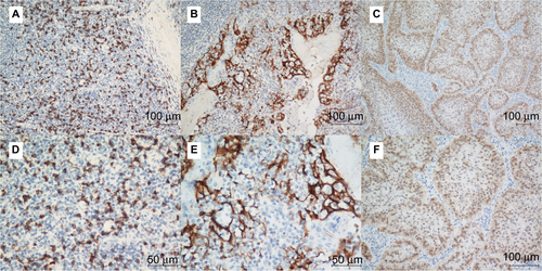 Figure S1 The tonsil tissue specimens were used as positive controls for CD8 (A and D) as well as PD-L1 (B and E) staining. The cervical squamous cell carcinoma specimens were used as positive controls for p16 staining (C and F).Note: Original magnification: ×200 (A, B and F), ×100 (C), and ×400 (D and E).Abbreviation: PD-L1, programmed death-ligand 1.