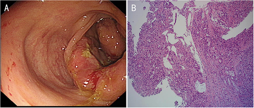 Figure 1 Colonoscopy showed ileocecal mass (A). Histopathological examination showed moderately and poorly differentiated adenocarcinoma (B).