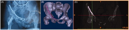 Figure 2. (A) Antero-posterior radiograph of the postoperative; (B) 3D rendering of the postoperative CT; (C) Anatomic reduction of articular surface.