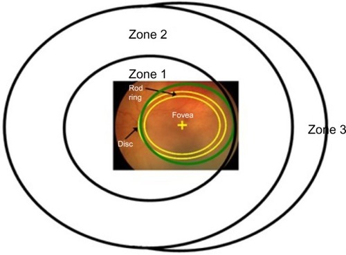 Figure 5 Diagram of the International Classification of Retinopathy of Prematurity zonesCitation24 with a superimposed fundus photograph on which the optic disc and fovea are indicated.