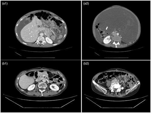 Figure 2. Radiological evaluation before surgery. (a) Axial contrast-enhanced CT images prior first stage surgery shows ascites (a1) and a large ill-defined multicystic mass within the abdominal cavity (a2). This complex cystic mass is seen repressing the intraperitoneal organ such as the right colon (a2 arrow). (b) Axial contrast-enhanced CT images performed just before the second time surgery show in comparison to images a1 and a2 the complete disappearance of ascites and of the complex cystic mass with the intraperitoneal organ back in their proper position in the abdominal cavity. Those results are in keeping with a complete radiological response of the first stage CRS/HIPEC oxaliplatin 250mg/m2
