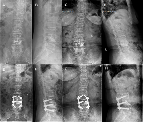 Figure 2 X-ray following vertebroplasty showed uniform distribution of bone cement in L4 vertebra (A and B). X-ray before revision surgery showed narrow intervertebral disc space at L3/4 and L4/5 with marked osteophyte formation at L3, L4, and L5 vertebra (C and D). X-ray immediately after revision surgery showed the placement of instrumentation (E and F). At 12 months after discharge, the X-ray showed no abnormal changes in instrumentation position (G and H).