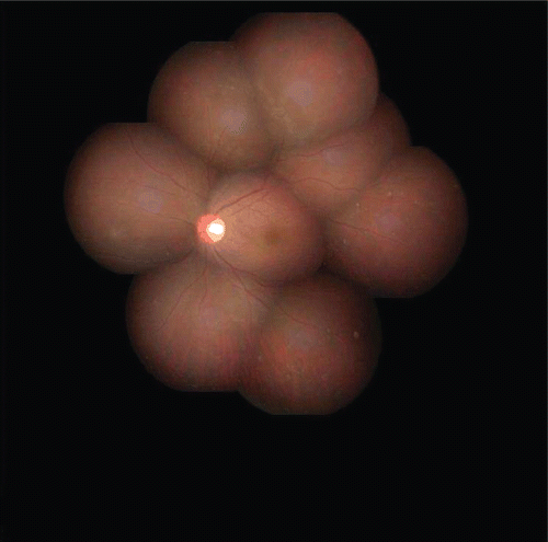 FIGURE 4  Fundus photograph of left eye post-therapy showing resolution of vasculitis and hemorrhage after 25 days of treatment.