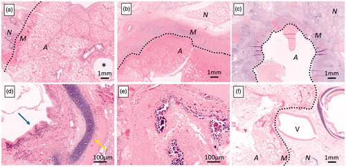 Figure 3. Histology of ablation zone. Histological specimen at day 2 (a, 1.25×, short duration) shows a well demarcated area of complete coagulation necrosis with a rim of hyperaemia, haemorrhage, and fibrin exudation at the edge of the area of necrosis. At day 28, a rim of dense fibrosis and inflammation characterised by infiltration by numerous neutrophils, macrophages, lymphocytes, and plasma cells is seen (b, 1.25×, long duration). Some lesions show cavitation within the dense rim (c, 1.25×, short duration). All bronchi were completely ablated inside the ablation zone. At day 2, the structure, including epithelium (blue arrow) or cartilage (yellow arrow) of bronchus is maintained (d, 20×, short-duration energy delivery), but is destroyed at day 28 (e, 20×, short-duration energy delivery). A 5mm pulmonary artery at the edge of the necrotic zone shows incomplete necrosis, and the ablation zone margin is concaved (f, 1.25×, short-duration energy delivery). A: ablated area; M: ablation margin; N: non-ablated area; *: antenna tract; V: pulmonary vein. Dotted lines demarcate the ablation zone from untreated lung.