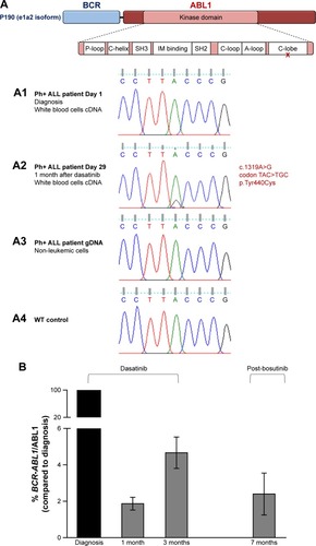 Figure 3 Ph+ ALL patient’s novel BCR-ABL1 point mutation and disease molecular monitoring.