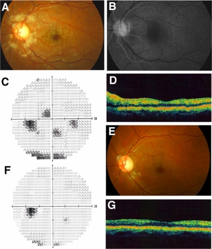Figure 2 Clinical findings for Case 2. Fundus photographs and fluorescein angiograms before treatment. There are many cotton wool patches surrounding the optic disc and retinal whitening surrounding the fovea (A). Fluorescein angiography showed nonperfused areas of retinal arterioles in areas corresponding to the cotton wool patches. The arm-to-retina time was 28 seconds (B). Humphrey static perimetry at onset (C) and 1 month later (F). Paracentral scotomas are almost gone. Fundus photograph 1 month after the onset (E). Most of the cotton wool patches and retinal whitening have disappeared. Optical coherence tomography at onset (D) and 1 month later (G). Swelling of the inner retina showing hyper-reflectivity was found at onset (D), but the hyper-reflectivity has disappeared and retinal thickness returned to normal 1 month after onset (G).