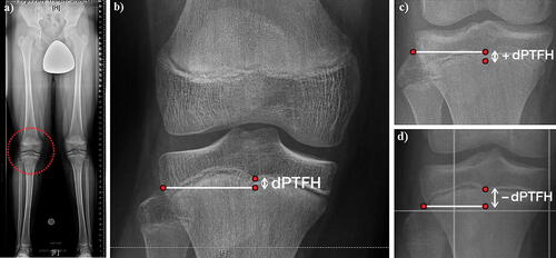 Figure 1. (a) The distance between the center of the proximal tibial growth plate and the tip of the fibular head (dPTFH) is measured in the frontal plane of long standing radiographs of a 13-year-old boy. (b) dPTFH is defined by the distance in millimeters between the center of the tibial growth plate and a line tangential to the tip of the fibular head and horizontal to the imaging plane. (c, d) Negative values indicate that the fibular head is localized more distally than the center of the proximal tibial growth plate and vice versa.