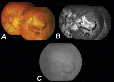Figure 2 A) Color-mosaic fundus picture of the left eye (LE) six months post-ICGA-guided argon laser showing a macular scar and almost complete resolution of the hemorrhagic pigment epithelial detachment (PED) temporal to the fovea. The appearance remained stable for another six months. B) Late phase of FFA of the LE resolution of the PED temporal to the fovea with hyperfluorescence due to staining of the fibrotic tissue. C) Late phase of ICGA at the same time showing the area corresponding to the PED with no active hot spots.