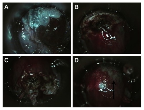 Figure 2 (A) High-resolution anoscopic appearance of previously biopsied AIN-2 lesion. (B) Appearance of the lesion after IRC. Lesion has been twisted with a Scopette and the coagulated tissue is buckled up. (C) Eschar is completely loosened by additional pressure with twisting of Scopette. (D) Eschar removed, note coagulated (arrow) and noncoagulated submucosal vessels.