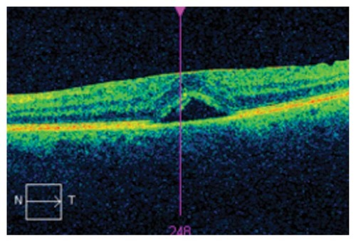 Figure 2 Optical coherence tomography demonstrating subretinal fluid in the left eye.