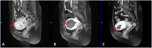 Figure 2. Pre- and post-HIFU MRI obtained from a 39-year-old patient with a large submucosal fibroid treated by HIFU. (A) Pre-HIFU contrast-enhanced MRI showed significant enhancement in the fibroid and the size of the fibroid was 5.4 cm × 5.0 cm × 5.2 cm (arrow). (B) One day post-HIFU MRI showed the NPV ratio was 92.5% (arrow). C. MRI obtained before hysteroscopic myomectomy showed the fibroid shrank significantly at 3 months after HIFU. The size of the fibroid was 2.4 cm × 2.6 cm × 2.3 cm (arrow).