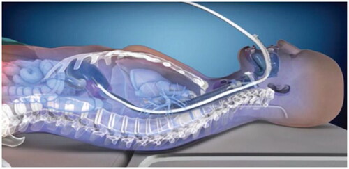 Figure 1. Active esophageal cooling device (with permission, Attune Medical, Chicago, IL).