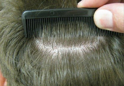Figure 4 Post-operative result of the same trichophytic closure, close up. Note that the person could wear his hair quite short and that there would be no evidence of the prior surgical procedure.