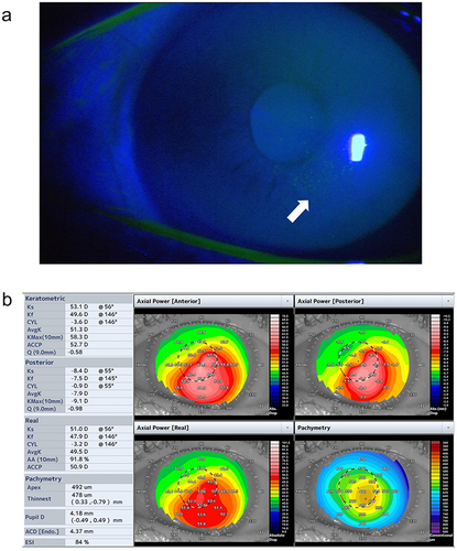 Figure 8 A representative case where YOUSOFT was highly useful. The patient was a 60-year-old female who had been wearing rigid gas permeable lenses but presented to the outpatient clinic complaining of difficulty wearing the rigid gas permeable lenses due to ocular pain. Corneal punctate epithelial damage caused by the rigid gas permeable lenses was observed (a, white arrow). Anterior segment optical coherence tomography results before prescribing YOUSOFT are shown in (b). Average keratometry was 51.3 diopters, corneal astigmatism was 3.6 diopters, corneal thinnest thickness was 478 µm, and severity was stage 2 according to the Amsler–Krumeich classification. The spectacle-corrected distance visual acuity (logMAR) was 0.7, and YOUSOFT-corrected distance visual acuity (logMAR) improved to 0.05. The patient was satisfied with the comfort and corrected visual acuity of the YOUSOFT.