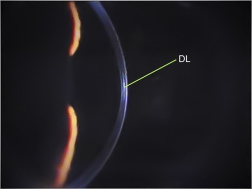 Figure 1 Biomicroscopic image of keratoconus eye at slit lamp 6 months after epi-off standard corneal CXL.