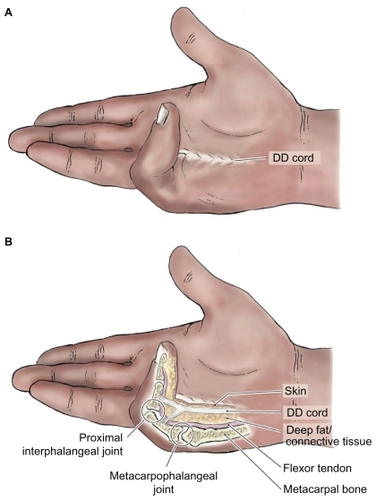 Figure 3 Diagram illustrating: A) hand with palpable “bow-stringed” Dupuytren disease (DD) cord. B) anatomical landmarks in DD-affected hand.
