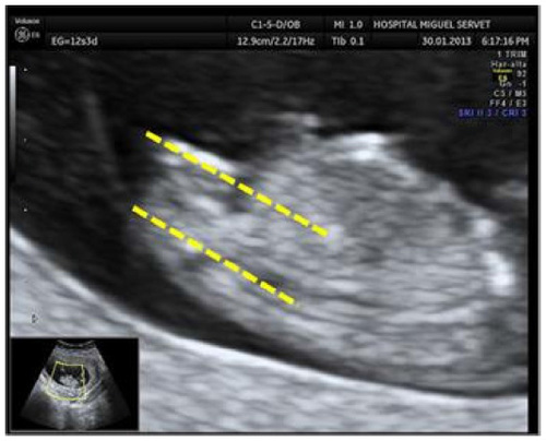 Figure 2 Female sex: ultrasound identification of the female fetal sex at first trimester ultrasound scan shows the genital tubercle parallel to the spinal column.