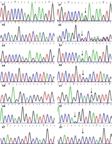 Figure 1. Information of mutant FXII DNA. (a1) NM_000505.4:c.398-1G > A in case 1. (a2) NC_000005.10:g.7217_7221delinsGTCTA in case 1. (b1) NM_000505.4:c.398-1G > A in case 2. (b2) NP_000496.2:p.(Ser479Ter) in case 2. (c1) NP_000496.2:p.(Pro182Leu) in case 3. (c2) NM_000505.4:c.1681-1G > A in case 3. (d1) NP_000496.2:p.(Cys559Arg) in case 4. (n) showed normal.