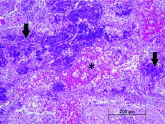 Figure 1. Large aggregates of degranulated eosinophils (arrows) surround a tract filled with hemorrhage and foamy macrophages (*).