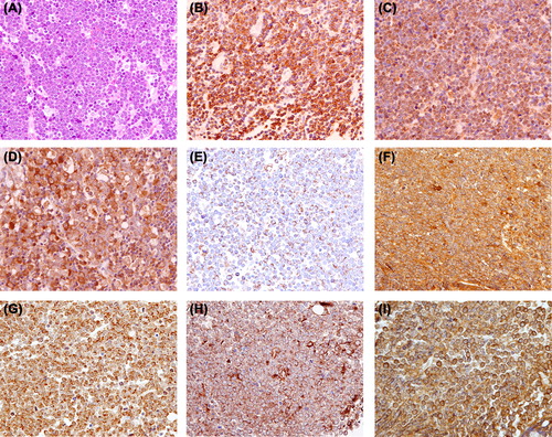 Figure 1. (A) Histological examination showing monotonous proliferation of medium-sized lymphocytes accompanied by a starry-sky appearance (hematoxylin-eosin stain; original magnification, 40×). (B) Lymphoma cells were positive for BCL2 (objective magnification, 40×). (C) Lymphoma cells were positive for MYC (objective magnification, 40×). (D) Lymphoma cells were positive for IL-6 (objective magnification, 40×). (E) Lymphoma cells were positive for TNF-α (objective magnification, 40×). (F) Lymphoma cells were positive for IL-6R (objective magnification, 40×). (G) Lymphoma cells were positive for TNFR1 (objective magnification, 40×). (H) Lymphoma cells were positive for TNFR2 (objective magnification, 40×). (I) Lymphoma cells were positive for CCR7 (objective magnification, 40×).