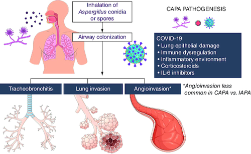 Figure 1. COVID-19-associated pulmonary aspergillosis pathogenesis.Invasive pulmonary aspergillosis is an opportunistic infection occurring in vulnerable patients after inhalation of conidia or spores of Aspergillus spp. SARS-CoV-2 pneumonia and ARDS create favorable conditions for Aspergillus growth and tissue invasion, causing epithelial lung damage, create an inflammatory environment, and dysregulating the immune response and clearance of the fungus, while corticosteroids and IL-6 inhibitors, used for severe COVID-19 treatment, also play a role in CAPA development.