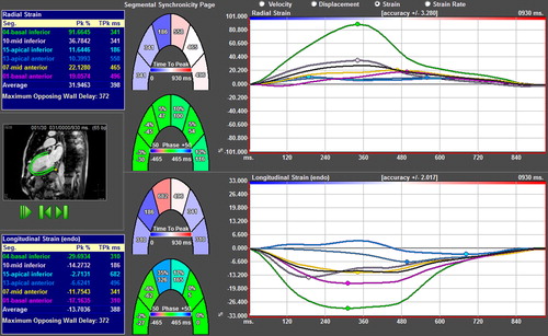 Figure 1. Viewport with strain curves from a patient with anteroapical infarction. Radial strain upper right and longitudinal strain lower right. Blue fields to the left display segmental values and green horseshoes in the middle display phase per segment.