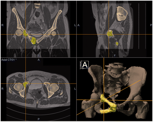 Figure 1. CT/MRI fusion with MRI-based tumor coloration using the OrthoMap Oncology Module (Stryker, Mahwah, NJ), showing the peri-acetabular part of the grade 2 chondrosarcoma.