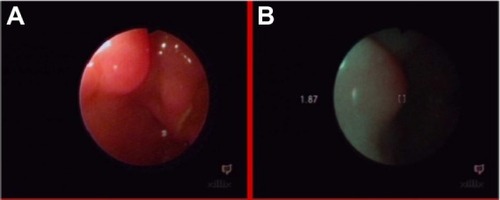 Figure 9 Estimation of radicality of polypectomy in white light (A) and autofluorescence (B) imaging.