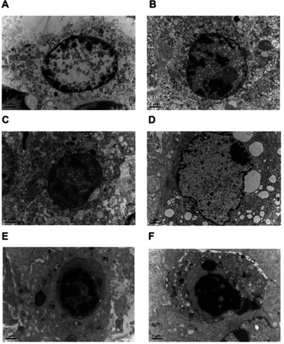 Figure 3 Electron microscopic examination of changes observed in the treatment and control groups (15,000×). Chromatin exhibited the edge-set phenomenon, and necrosis was observed. These effects were more prominent in the high-dose miR-145 treatment group. (A) Unmanipulated control group, (B) glucose solution control group, (C) transfection reagent control group, (D) non-specific gene sequence control group, (E) miR-145 high-dose (1.0 OD) group, and (F) miR-145 low-dose (0.5 OD) group.