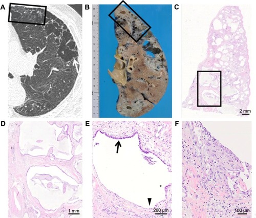 Figure 5 Computed tomography images and their corresponding histological images of left upper lobe.