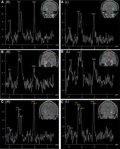 Figure 1 1H-MR spectrum and MRI of individual patients. (A) 1H-MR spectrum and MRI of patient 13 (31-year-old female; seizure history, 20 years; right [NAA/Cho + Cr] =0.48, left [NAA/Cho + Cr] =0.42; seizure focus in the left temporal region; left HS; surgical outcome, Engel class I). (B) 1H-MR spectrum and MRI of patient 7 (38 year old male; seizure history, 28 years; right [NAA/(Cho + Cr)] =0.26, left [NAA/(Cho + Cr)] =0.35; seizure focus in the right temporal region; right HS; surgical outcome, Engel class II). (C) 1H-MR spectrum and MRI of patient 20 (24-year-old female; seizure history, 22 years; right [NAA/Cho + Cr] =0.56, left [NAA/Cho + Cr] =0.48; seizure focus in the bilateral temporal regions; right HS; surgical outcome, Engel class II).